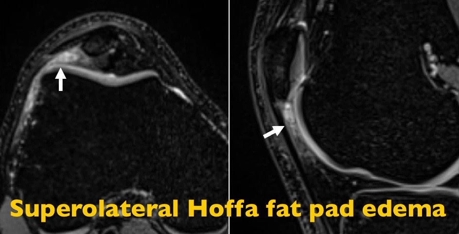 New 🇨🇭Alpine Ski study! 👉 Superolateral #Hoffa fat pad #edema is a frequent cause of anterolateral knee pain and increases during adolescence over 4-year follow up! Download #OpenAccess: 👉insightsimaging.springeropen.com/articles/10.11… #MSKrad | #SportsMedicine | @derbalgrist @swissskiteam @UZH_en