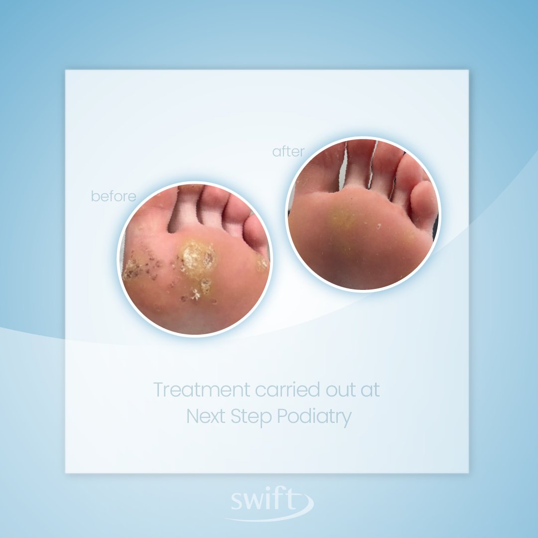 This young woman was suffering with painful verrucas on the ball of her foot whilst playing tennis. 

After just a few treatments with Swift, the verrucae were gone and she was able to hit the court, pain-free again.

Treatment carried out by
