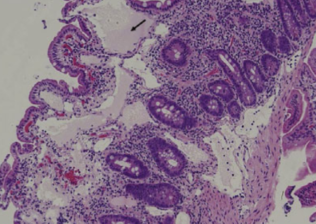 JPGNonline's tweet image. 14 yo 👦 post-renal tx for IgA nephropathy with abdo pain and diarrhea x months

#Endoscopy: enlarged white villi in duodenum/jejunum; histology shows dilated lymphatic spaces

Most likely diagnosis?

Answer and learn more 👉 onlinelibrary.wiley.com/journal/153648…

#imageofthemonth #quickpoll