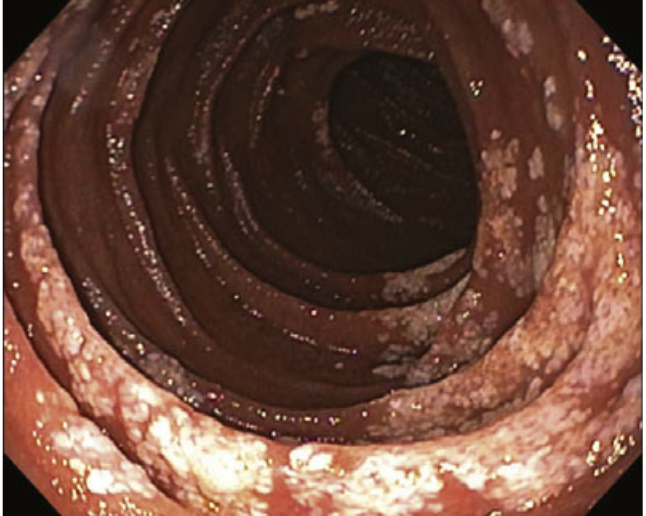 JPGNonline's tweet image. 14 yo 👦 post-renal tx for IgA nephropathy with abdo pain and diarrhea x months

#Endoscopy: enlarged white villi in duodenum/jejunum; histology shows dilated lymphatic spaces

Most likely diagnosis?

Answer and learn more 👉 onlinelibrary.wiley.com/journal/153648…

#imageofthemonth #quickpoll