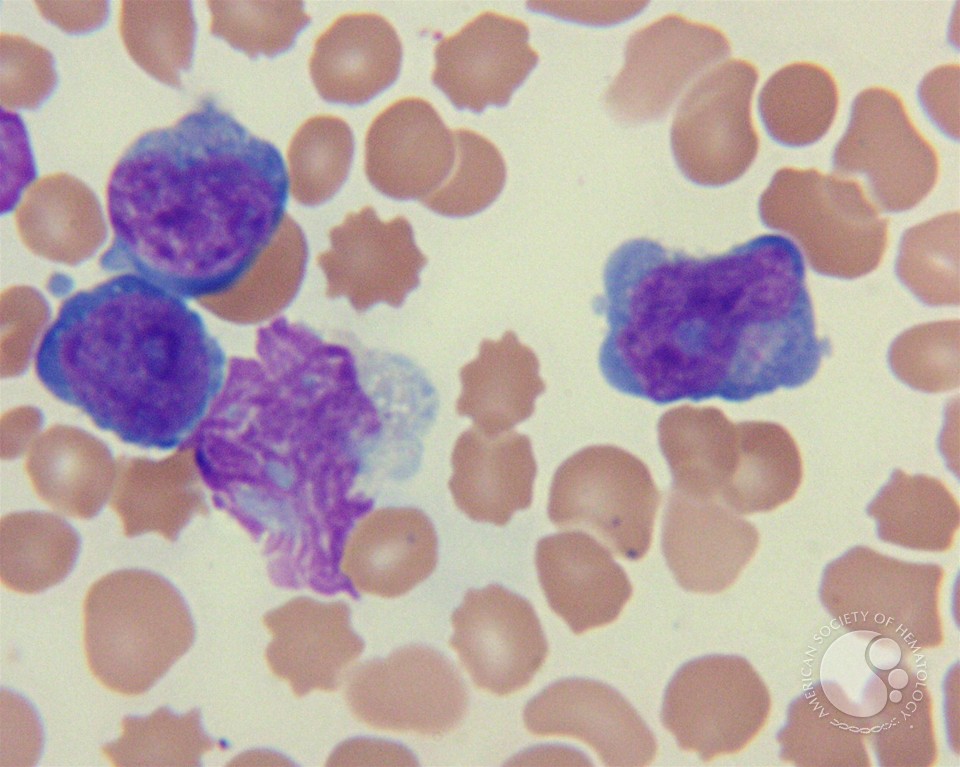 T-cell prolymphocytic leukemia  | ASH Image Bank | American Society of Hematology imagebank.hematology.org/image/3881/tce… #ASHImageBank