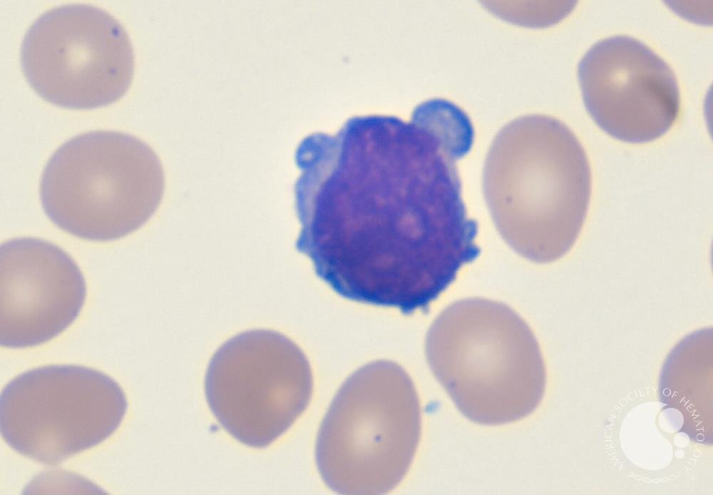T-Prolymphocytic leukemia | ASH Image Bank | American Society of Hematology imagebank.hematology.org/image/61680/tp… #ASHImageBank