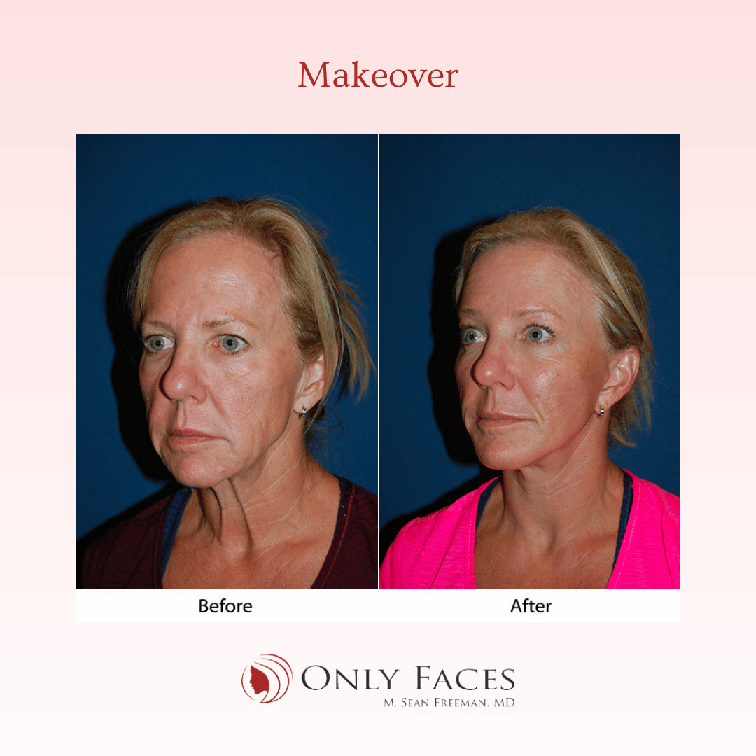 OnlyFacesCLT's tweet photo. This 54-year-old is five months post-op from a Segmental Endoscopic #BrowLift: 3/4-R/L, Deep Plane #MiniTuck, Lower lid: SOOF lift #blepharoplasty, and Ablative CO2 laser resurfacing of full face. #OnlyFaces https://t.co/QAqSIS4Uyd