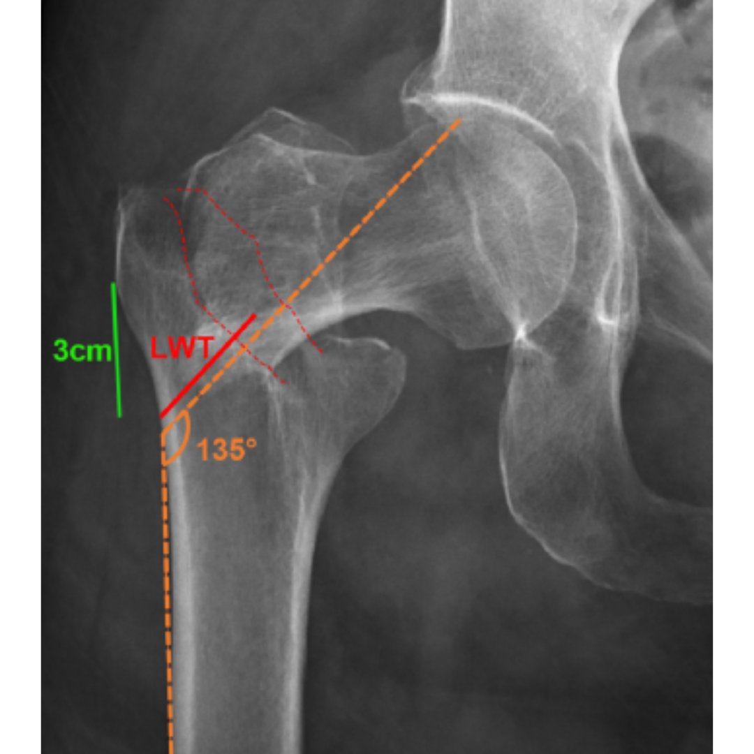 Bone & Joint Open (@bonejointopen) on Twitter photo Lateral wall thickness was not associated with risk of revision surgery in patients with an intertrochanteric fracture fixed with sliding hip screw when the medial calcar was intact.
#BJO #Fracture #Surgery #OpenAccess <a href="/DuckworthOrthEd/">Andrew D Duckworth</a> <a href="/docfarrow/">Luke Farrow</a>
ow.ly/m6I250QIf8Y Lateral wall thickness was not associated with risk of revision surgery in patients with an intertrochanteric fracture fixed with sliding hip screw when the medial calcar was intact.
#BJO #Fracture #Surgery #OpenAccess <a href="/DuckworthOrthEd/">Andrew D Duckworth</a> <a href="/docfarrow/">Luke Farrow</a>
ow.ly/m6I250QIf8Y
