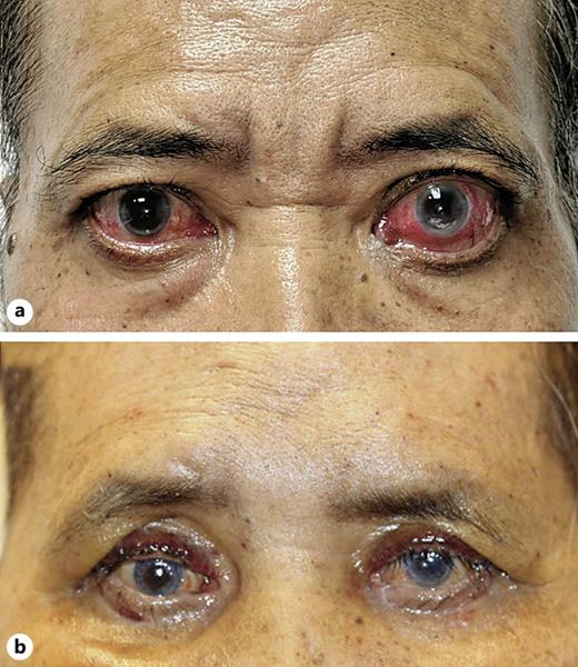 Long-Term Follow-Up of a Case of Severe Hyperglycemia Requiring Hospitalization after Third Dose of Teprotumumab: A Case Report  

➡️ ow.ly/4wOf50Qz4RL
✍️ Mehta P. et al.  
📖 #CaseRepOphthalmol 

#OpenAccess