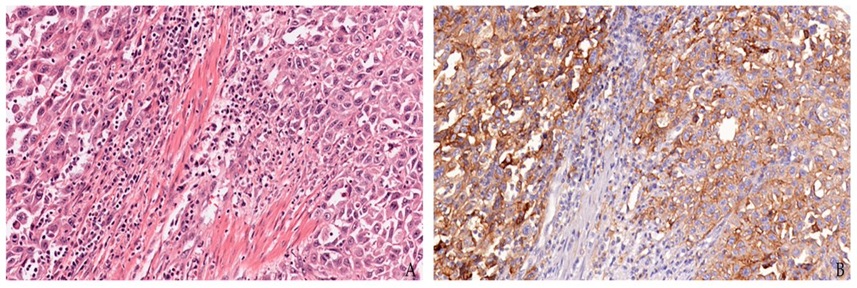 🤩Happy to share the #Editor_Choice and #Highly_Cited Paper 'Atlas of PD-L1 for Pathologists: Indications, Scores, Diagnostic Platforms and Reporting Systems' 👨‍🔬Stefano Marletta et al. 🔥Citations 33 🔗mdpi.com/1704130 @MDPIOpenAccess @MediPharma_MDPI