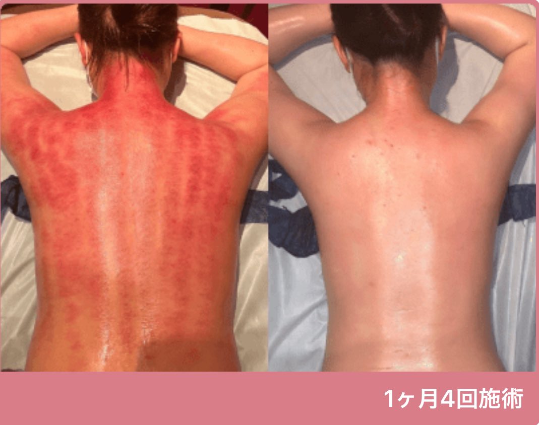 1ヶ月でここまで変わるのは
#セルライトクラッシュ　だから！

#Speed美人
#セルライトクラッシュ