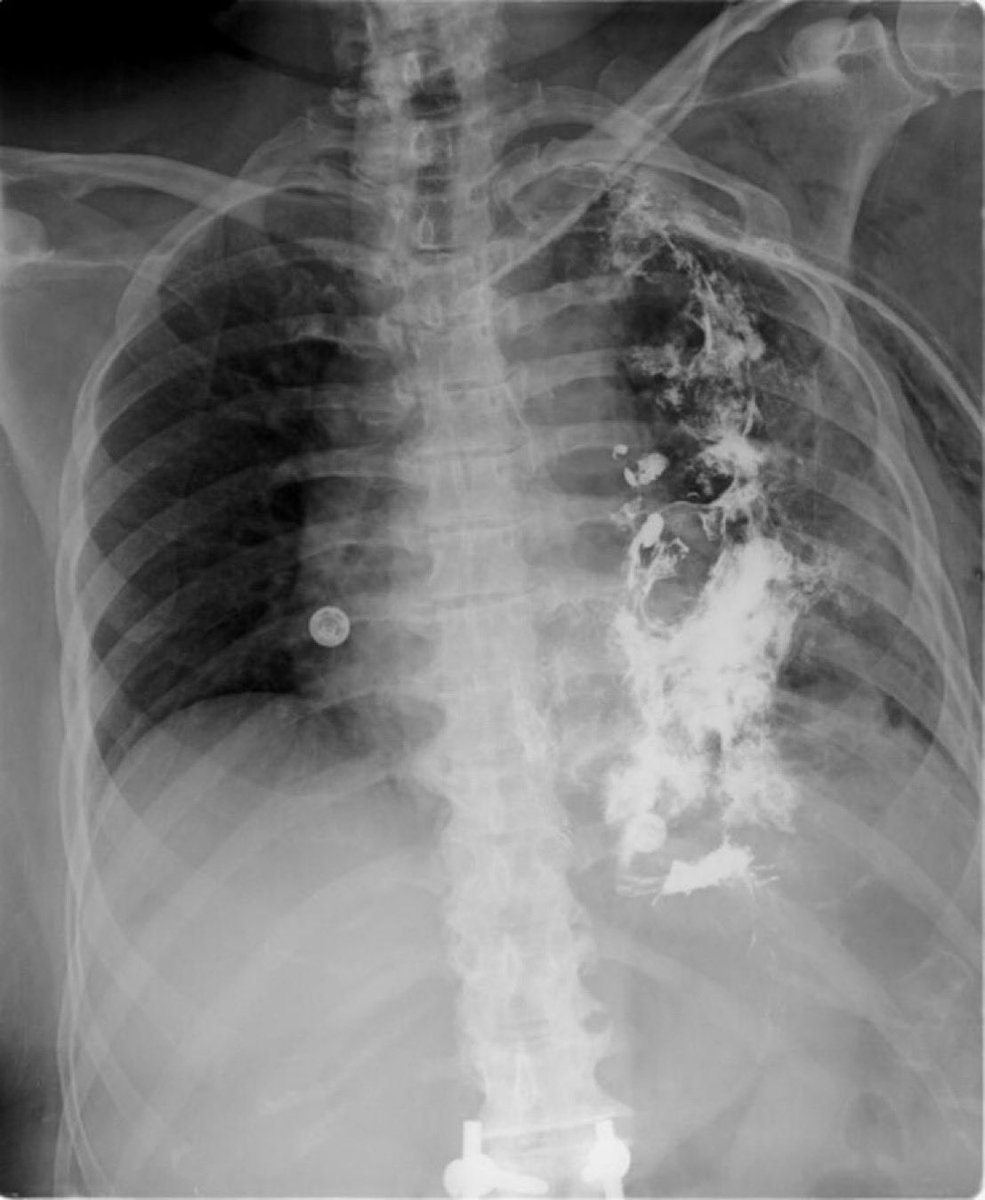 A 50 year old woman presented with recurrent episodes of vomiting followed by sharp chest pain. A fluoroscopy xray was obtained. What is the likely diagnosis/triad? (Image @Radiopaedia, case by Dr Ahmed Abdrabou) #Medtwitter