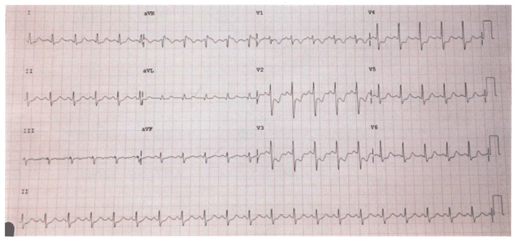 12_Derivaciones's tweet photo. 🤰Parto en curso, 39 años de edad y gestante de 34 semanas, tras administrar efedrina se observa este ECG
✍️ Descenso difuso segmento ST con ascenso aVR, patrón de isquemia difusa, en este caso, por aumento de demanda miocárdica de oxígeno
✅️ Preguntado #MIR2016-#MIR2017 https://t.co/rH7txJWtQa