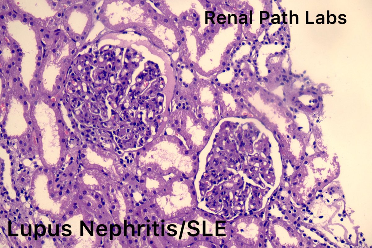 Apart from MCD/FSGS/PIGN/DDD-we get pediatric renal cases with following diagnosis: IgAN, SLE, TMA, ANCA GN. What is common at your centre??
#RenalPath #PediatricRenal #NephPath #AskRenal #RenalPathSociety #AskRenalPath #PathTwitter
#PoojaMaheshwari #Nephropathologist