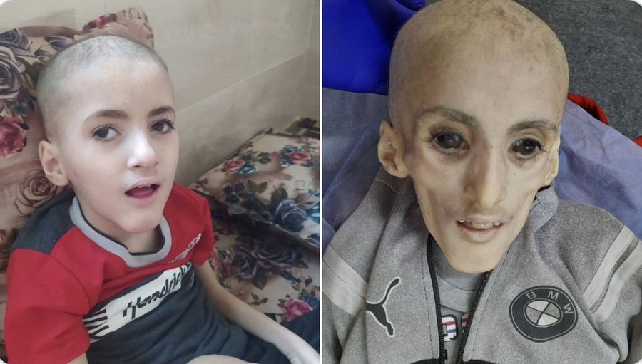 Gaza Genocide His name was Yazan Kafarnah, he just died of hunger.
#Gaza