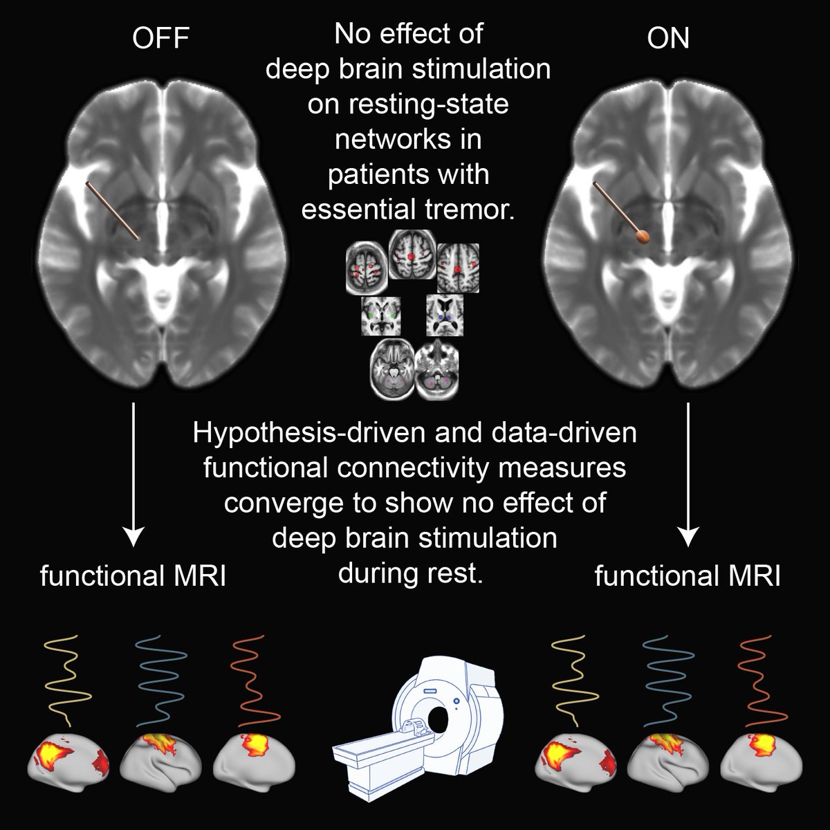 braincomms's tweet image. Awad et al. report, using resting-state fMRI, that #deepbrainstimulation does not modulate resting-state functional connectivity in #essentialtremor. shorturl.at/aqtvD