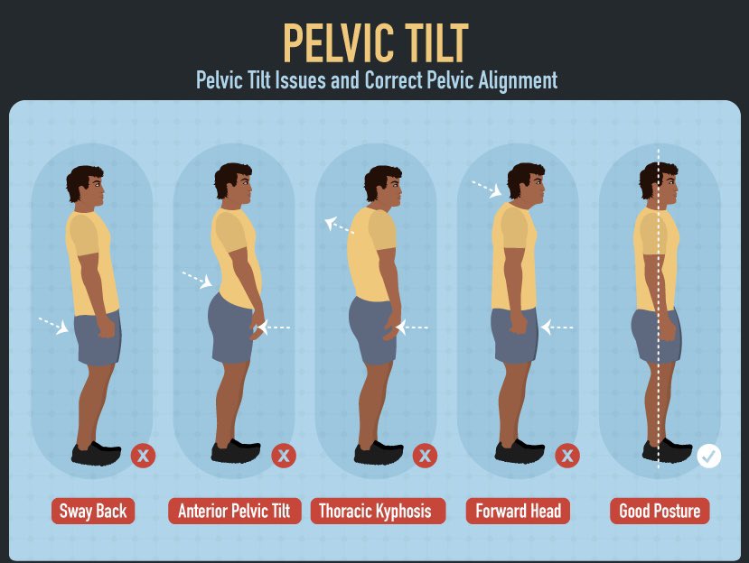 boyner_clinic's tweet image. Unlocking the secrets to a healthier body! 🌟 Pelvic tilt matters more than you think. Learn about common issues and discover the key to correct pelvic alignment. Your foundation for a pain-free, strong posture starts here! 💪 #PelvicHealth #PostureAlignment #wellnessjourney