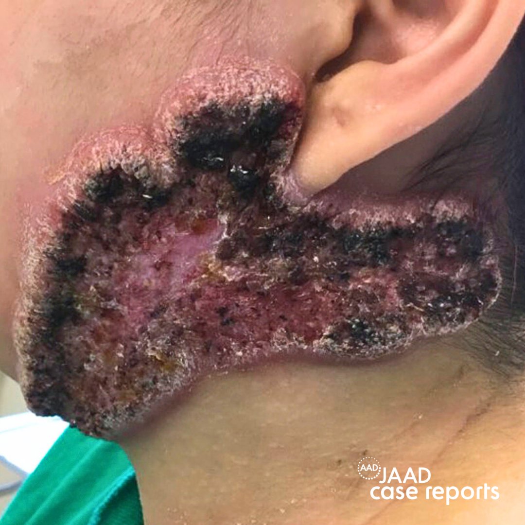 What is the #diagnosis? A healthy 23-year-old Hispanic woman from Illinois presented with a 10-month history of a verrucous plaque on the left lower face. She had been treated for a pneumonia just prior to the plaque developing. @jaadjournals jaadcasereports.org/article/S2352-…