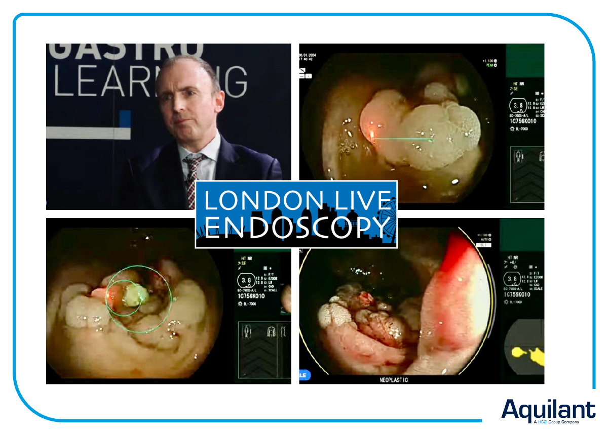 We had a great 2 days at #LLE, Ed Seward expertly demonstrating the #Fujifilm #ScaleEye colonoscope in accurately measuring polyp size and utilising #CADEYE #AI technology to characterise this “Neoplastic” Polyp with the BLI modality.