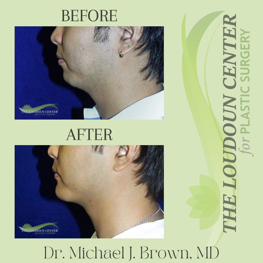 Wow🤩What a transformation! Schedule your consultation with Dr. Brown today... just imagine the possibilities! #PlasticSurgery #TopDocs #DMVPlasticSurgeon #ChinAugmentation #ChinImplant #BeforeAndAfter