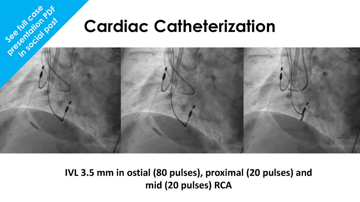 This case for International Women’s Month features an 81 yo female patient with nodular calcium in the ostial RCA and diffuse disease in the prox &amp; mid RCA. Dra. <a href="/Alepineiro_/">Ana Ledo Piñeiro</a> and Dr. <a href="/RodrigoEstvez1/">Rodrigo Estévez</a> from Complejo Hosp. Univ. Vigo in Spain used 120 pulses of #ShockwaveC2plus to