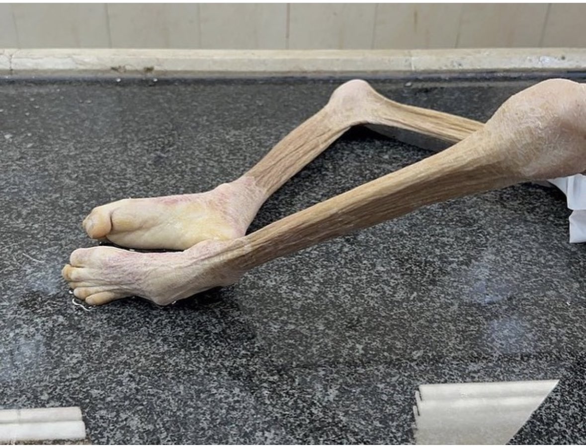 هذا ما فعله الجوع بأبن عائلتي الطفل يزن شريف الكفارنة ، ي أمة المليار أطفالنا وعائلاتنا تموت وهي جوعى ، لا سامحكم الله ولا بارك الله في أموالكم ، كلكم خصامنا يوم الحساب .