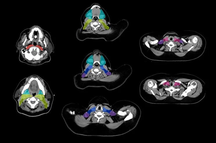 The recent study led by Gustavo R. Sarria, MD and team highlights the practical benefits of #LimbusContour in treatment planning. Achieving time savings and accurate AI-generated contours. 

Read more: buff.ly/49ixXUg 

#AI #Radonc #MedPhys #Dosim #Research