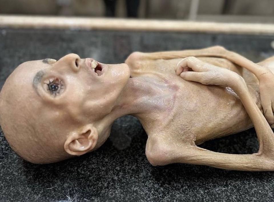 Palestinian bodies turned into skeletons in Gaza 🇵🇸