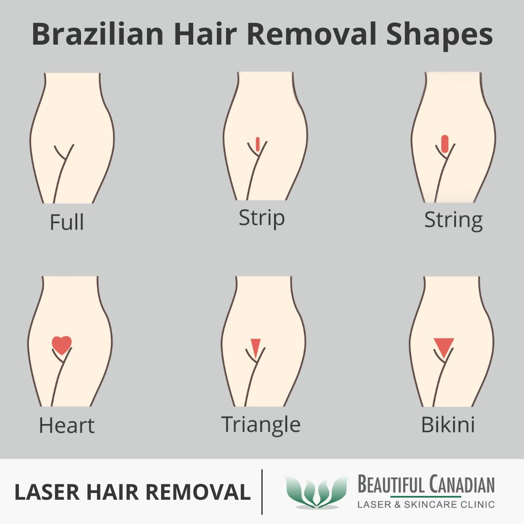 When you opt for laser hair removal, BE SURE you are clear about the type of bikini line you want to keep (if any!).

BTW, Summer bodies are made in winter! Start now!

l8r.it/VtRD

#brazilian #laserhairremoval #hairremoval #vancouverlaserclinic #surreylaserclinic