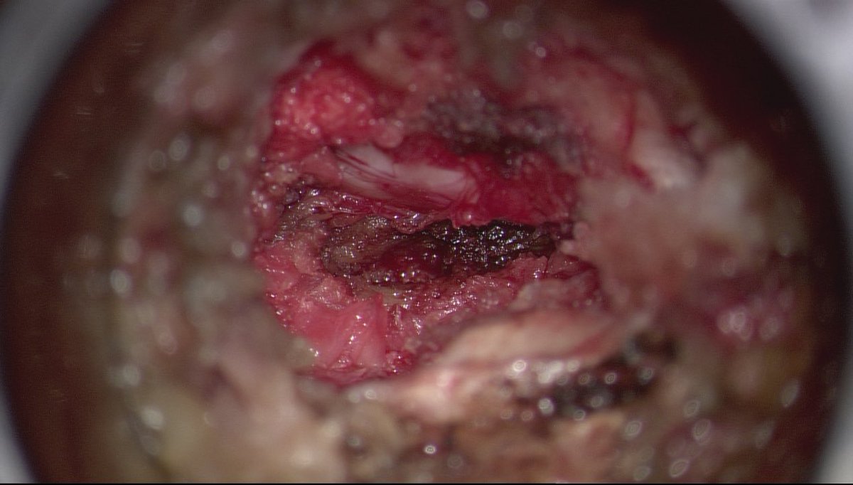 The MIS tube is a great retractor for microdiscs. It’s also a great retractor for recurrent microdiscs as in this case. A third herniation = fusion. #neurosurgery