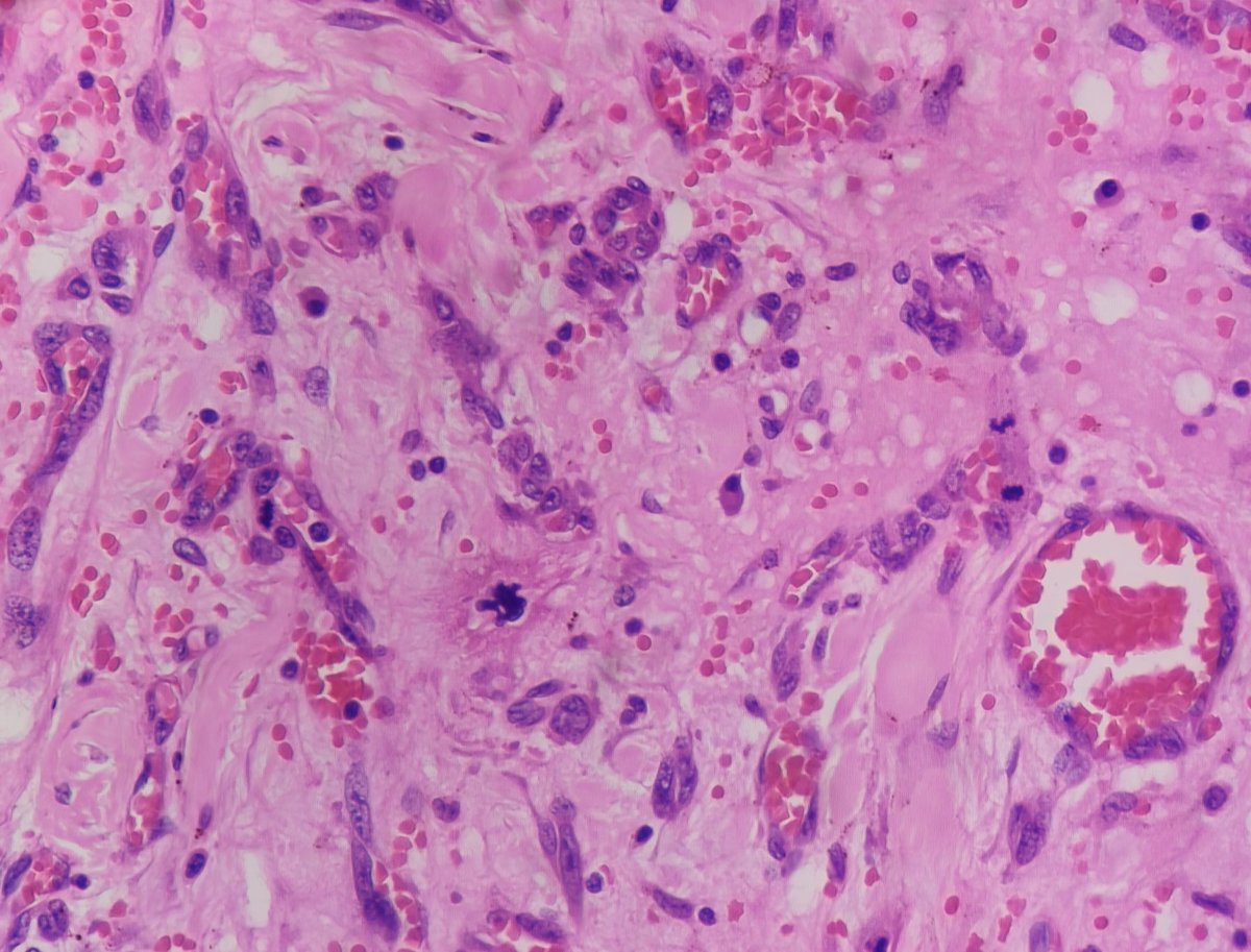 55/F arm lesion . Is it #tooclosetodiagnose?