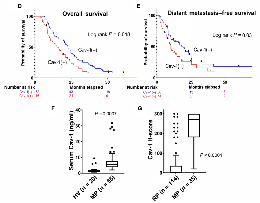 Terry Williams (@tewilliamsmd) on Twitter photo 4/n  Proteomic profiling revealed Cav-1 was overexpressed in higher grade #PDAC and associated with worse clinical outcomes in our own institutional dataset, and higher Cav-1 expression was detected in serum and metastases in patients with metastatic #pancreaticcancer. 4/n  Proteomic profiling revealed Cav-1 was overexpressed in higher grade #PDAC and associated with worse clinical outcomes in our own institutional dataset, and higher Cav-1 expression was detected in serum and metastases in patients with metastatic #pancreaticcancer.