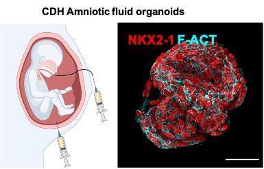Amazing working with fetal medicine specialists <a href="/PrenatalTherapy/">Anna David</a> <a href="/uclh/">UCLH</a> Jan Deprest and Francesca Russo <a href="/KU_Leuven/">KU Leuven</a> @uzleuven to define organoids from congenital diaphragmatic hernia <a href="/CDHUK_CHARITY/">CDH UK</a> <a href="/NIHRresearch/">National Institute for Health and Care Research</a> <a href="/UCLTRO/">UCL Translational Research Office</a> <a href="/GerliLab/">Mattia FM Gerli, PhD</a> <a href="/DBC_ICH/">Developmental Biology & Cancer</a> nature.com/articles/s4159…