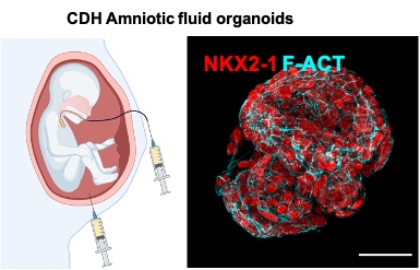 Amazing working with fetal medicine specialists @PrenatalTherapy @uclh Jan Deprest and Francesca Russo @KU_Leuven @uzleuven to define organoids from congenital diaphragmatic hernia @CDHUK_CHARITY @NIHRresearch @UCLTRO @GerliLab @DBC_ICH nature.com/articles/s4159…