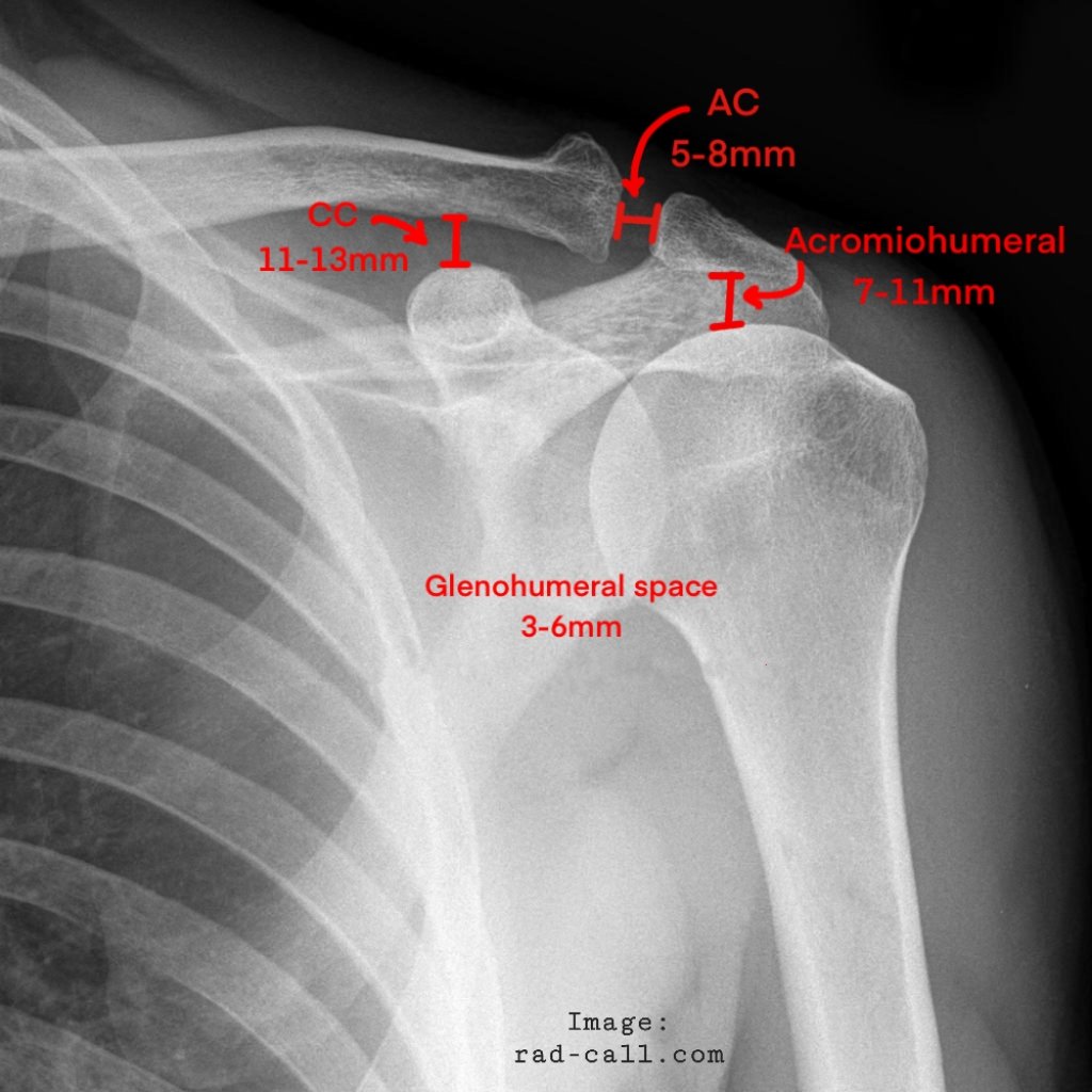 NORMAL SHOULDER MEASUREMENTS on AP view: ●GHJ space <6 mm. ●ACJ should be no greater than 7 mm. ●Coracoclavicular distance no greater than 13 mm ●AHD (Acromiohumeral distance) <7 mm is highly suggestive of a large rotator cuff tear.