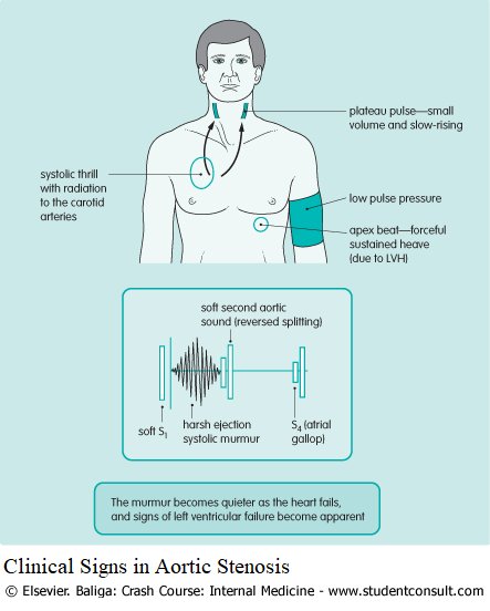 🔴 Heart Murmurs – Differential Diagnosis, Examination and Investigations <a href="/ManualOMedicine/">Manual Of Medicine</a>

manualofmedicine.com/topics/cardiol…
#cardiology #cardiotwitter #CardioEd #MedEd #medtwitter #cardiox