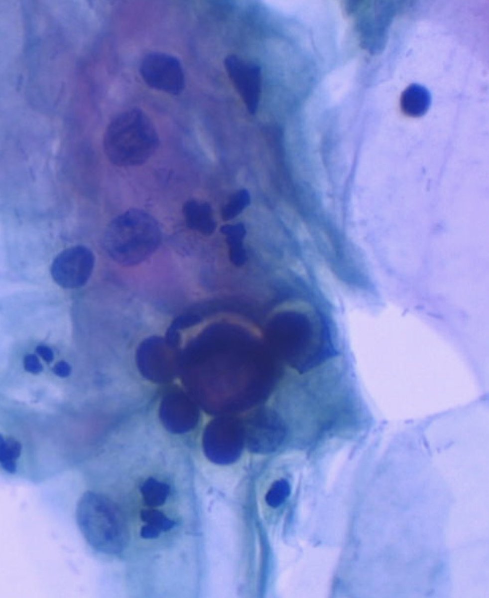 I do not have the final answer, but I think there is a special fungus in this Pap smear😁 Paracoccidioidomycosis? 🤔😁 #fungus #cervicalcancer #papsmear #womenhealth #medicine #cytology #cytopathology #pathology #microbiology