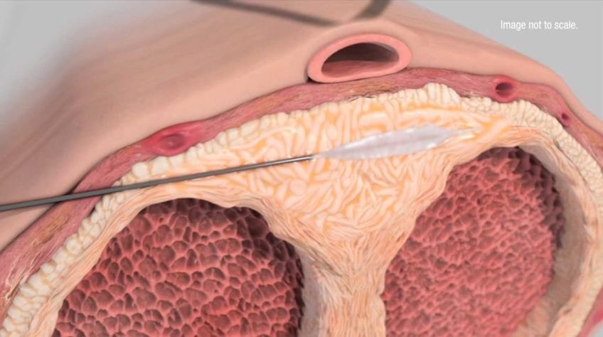 Non-surgical treatment of Peyronie's Disease: FDA approved treatment is injectable collagenase clostridium histolyticum (CCH). How? Degrades the collagen plaque causing the curvature. Note: Use caution to avoid urethral injury when using for ventral plaque