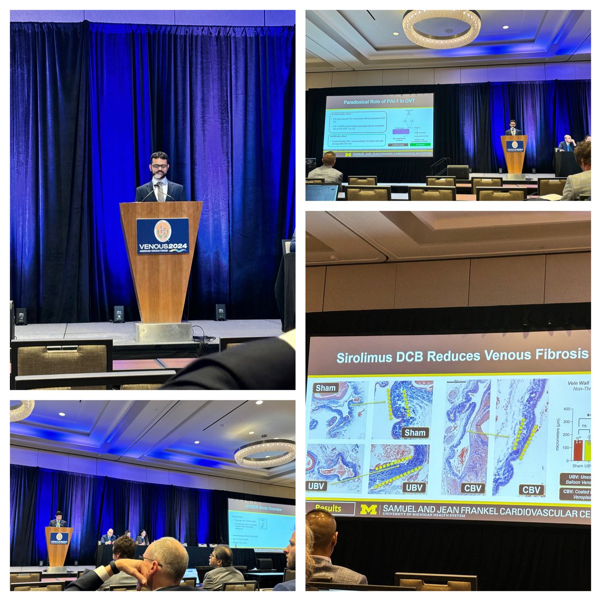 Andrea Obi MD (@andreaobimd) on Twitter photo Back to back talks on utility of sirolimus dcbs and targeting of vitronectin pai-1 domain as mechanisms for reducing post dvt vein wall injury. Proud of these young scientists. <a href="/OscarMorenoMD/">Oscar Moreno, MD</a> <a href="/UoMVascSurgery/">UoM Vascular Surgery</a> <a href="/VenousForum/">American Venous Forum | AVF</a> #jobst #venous2024 <a href="/henke1965/">peter henke</a> <a href="/thomaswakefield/">Thomas Wakefield</a> Back to back talks on utility of sirolimus dcbs and targeting of vitronectin pai-1 domain as mechanisms for reducing post dvt vein wall injury. Proud of these young scientists. <a href="/OscarMorenoMD/">Oscar Moreno, MD</a> <a href="/UoMVascSurgery/">UoM Vascular Surgery</a> <a href="/VenousForum/">American Venous Forum | AVF</a> #jobst #venous2024 <a href="/henke1965/">peter henke</a> <a href="/thomaswakefield/">Thomas Wakefield</a>