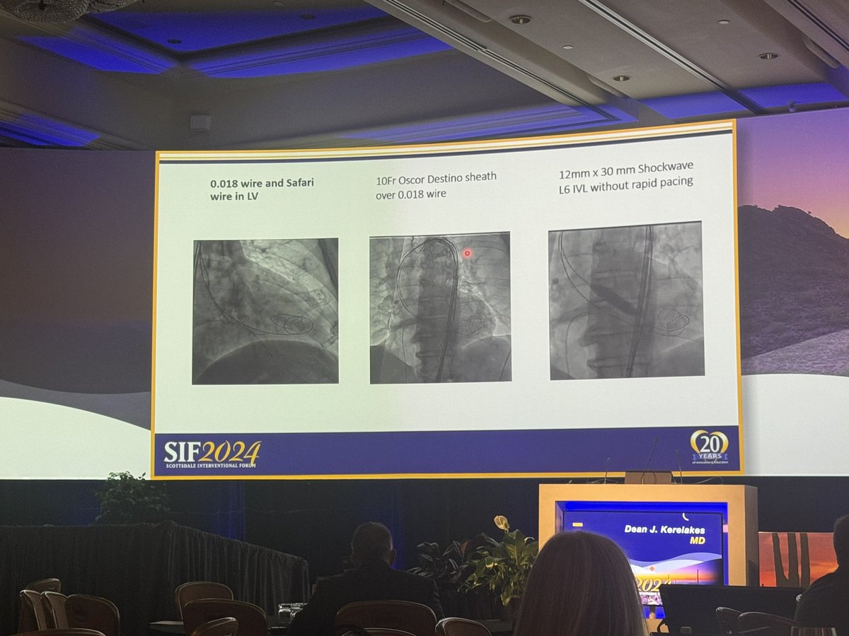 The Evolving Use of Intravascular Lithotripsy in Valvular Heart Disease
We’re all heard abt IVL for midsize vessels; however, for AV and MV!! Great talk by Dean J. Kereiakes, MD #SIF2024