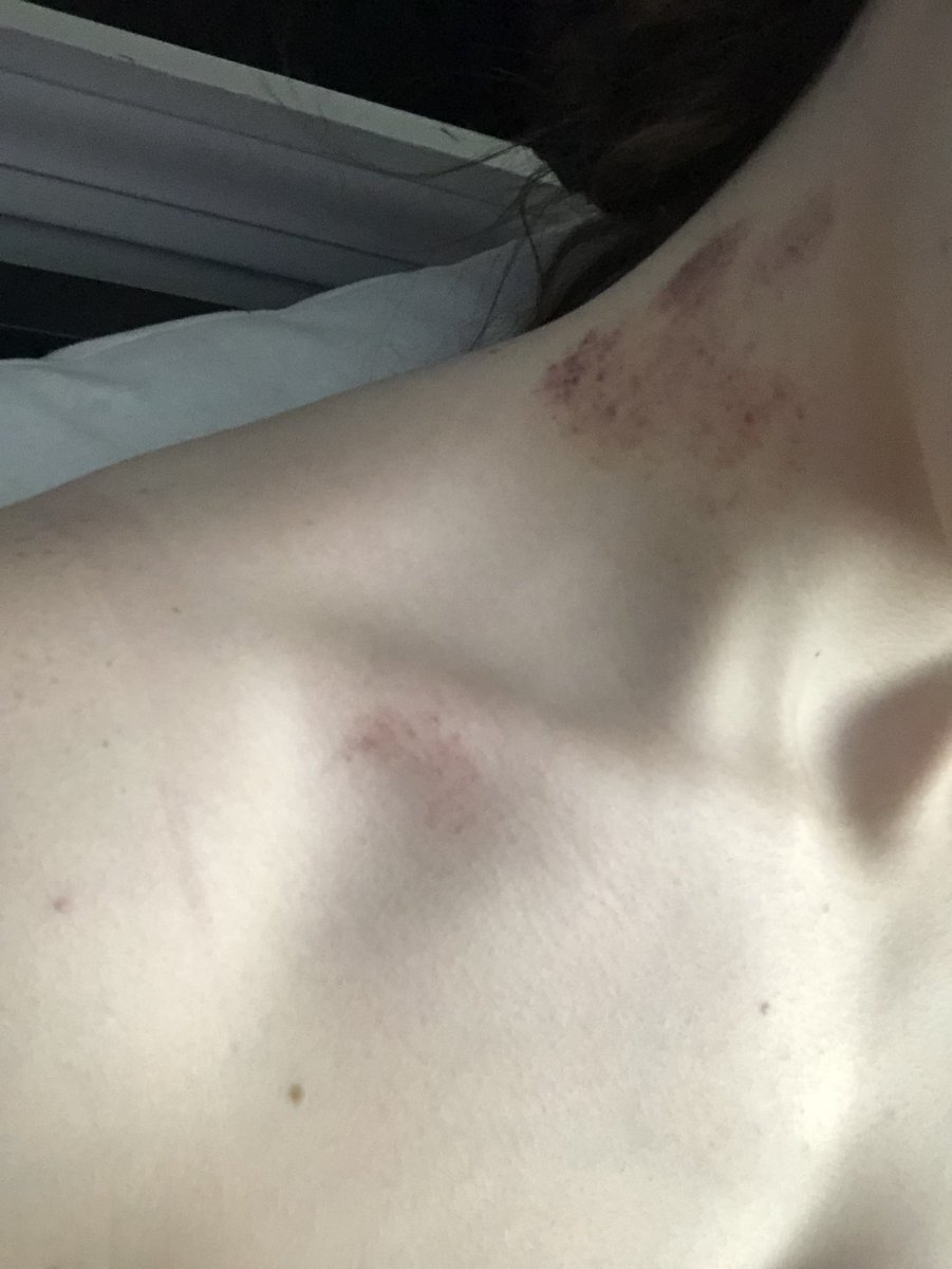 braindead_slut's tweet photo. New hickeys :3 also reminder I also have a masculine account and I’m starting to be more active there, dm me for the @ #nsfwtwt #seling https://t.co/jZGp1CmJfz