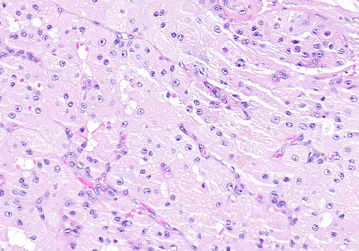 Parotid gland, adult

#ENTpath #Pathtwitter #Pathreisdents #pathology