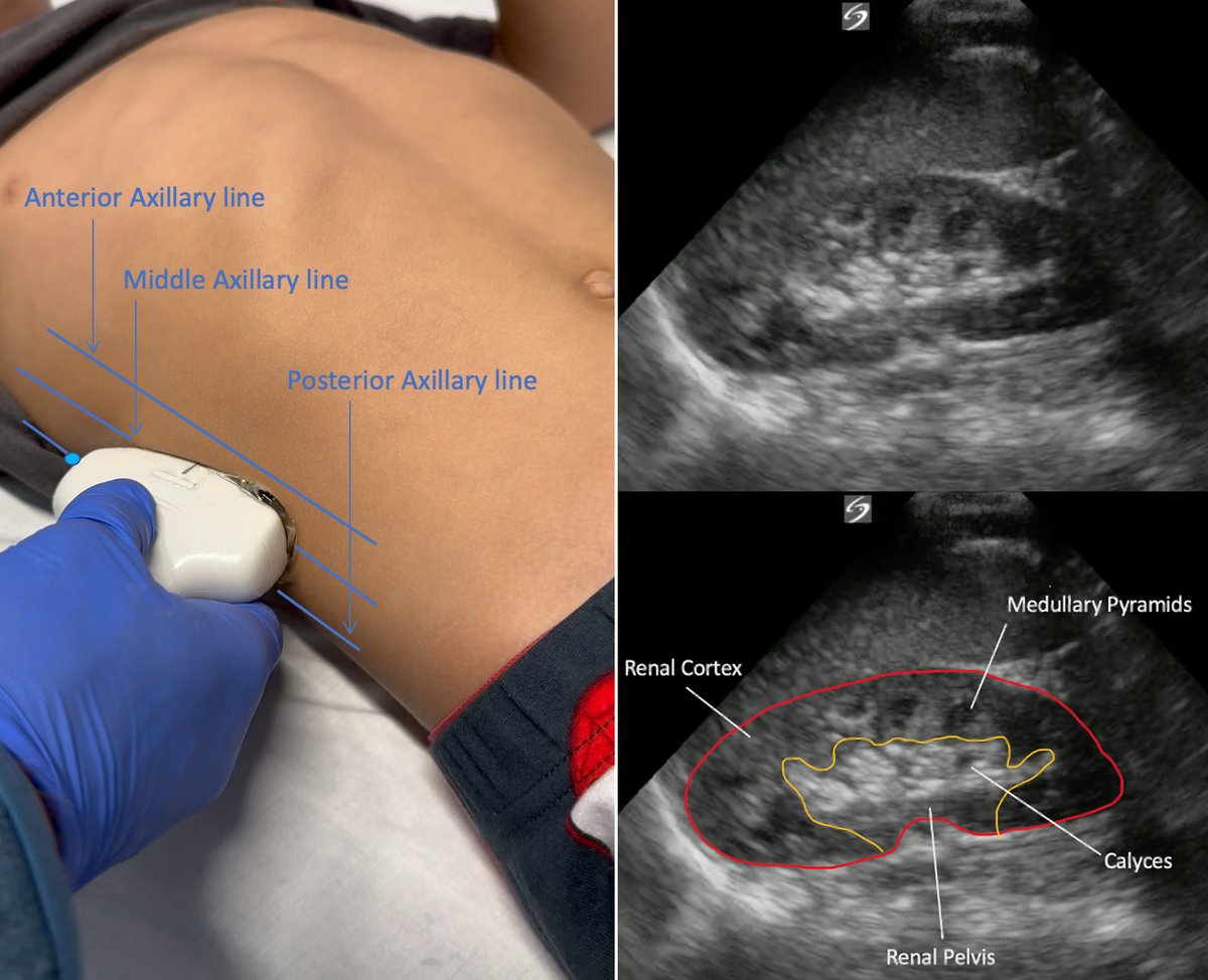 PEM POCUS: Pediatric Renal and Bladder Ultrasound - The ultimate guide for performing this useful exam in children👧 By Drs. Sosa and Firnberg (expert peer-reviewed by Drs. @margalinma @AshkonMD @AaronKornblith @LillyBellman). Free quiz at ALiEMU. aliem.com/pem-pocus-seri…