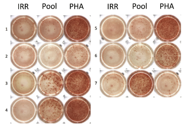 ScienceTM's tweet photo. A #neoantigen discovery pipeline combines whole-exome sequencing with blood cell stimulation to identify and validate promising neoantigens—offering a less tedious and more accessible method to uncover new targets for cancer #immunotherapy.  @ljiresearch https://t.co/SYnBQiemvX https://t.co/x9Da4bRPgR