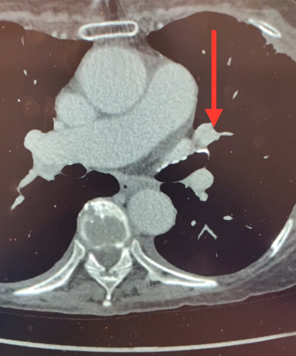 Abnormal lung can result in increased vascular resistance. So ddx is thrombus or slow flow/delayed perfusion. Latter was suspected so study was repeated with a delay. See pic - defect filled in. No PE, but rather slow flow. Have a great week! Be kind! ❤️