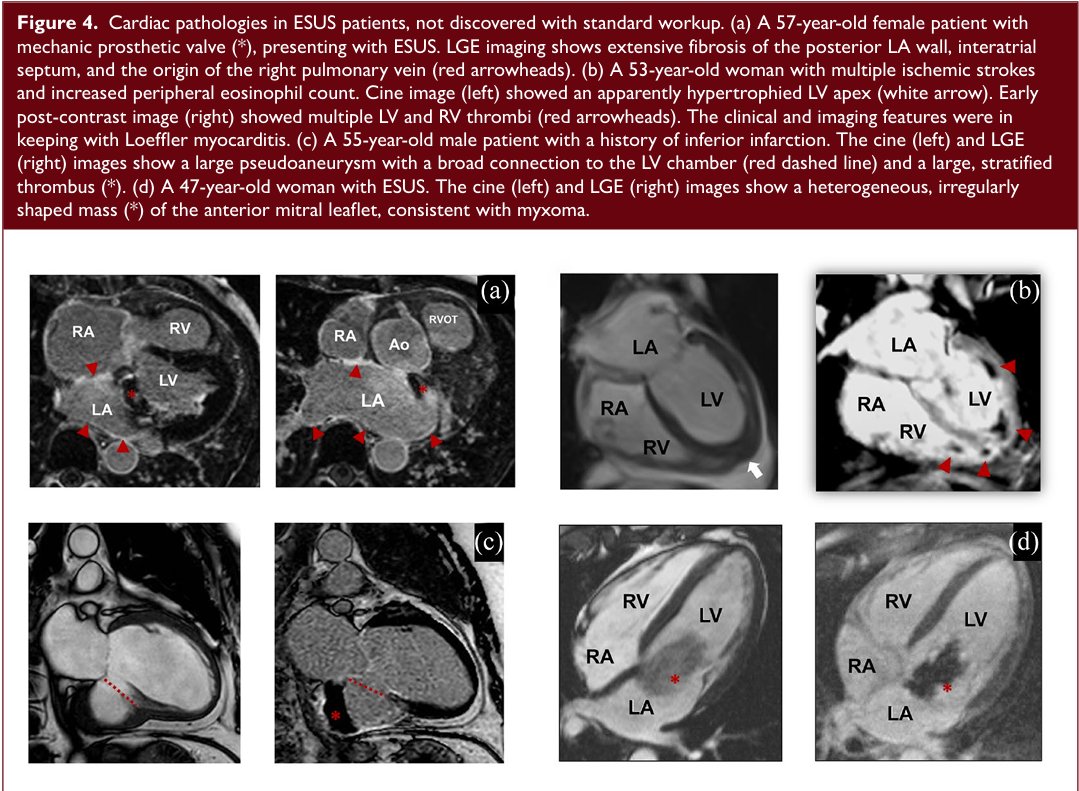 #MondayTip 🧐The role of #MRI in diagnostic workup of #ESUS ☝️6.1% to 82.3% of patients w/ESUS were #reclassified using of MRI techniques like #cardiac MRI, MRA and/or #vesselwall MRI (vs standard workup) depending on the combination of imaging modalities journals.sagepub.com/doi/10.1177/17…