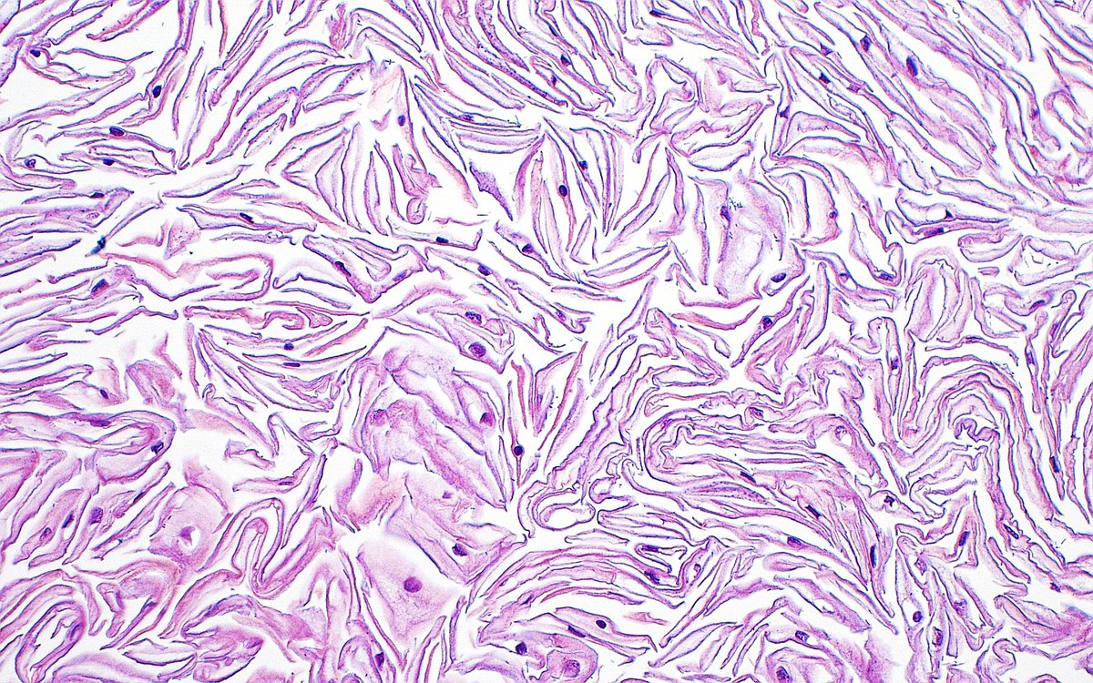 Keratin and Squames ~ #PathArt