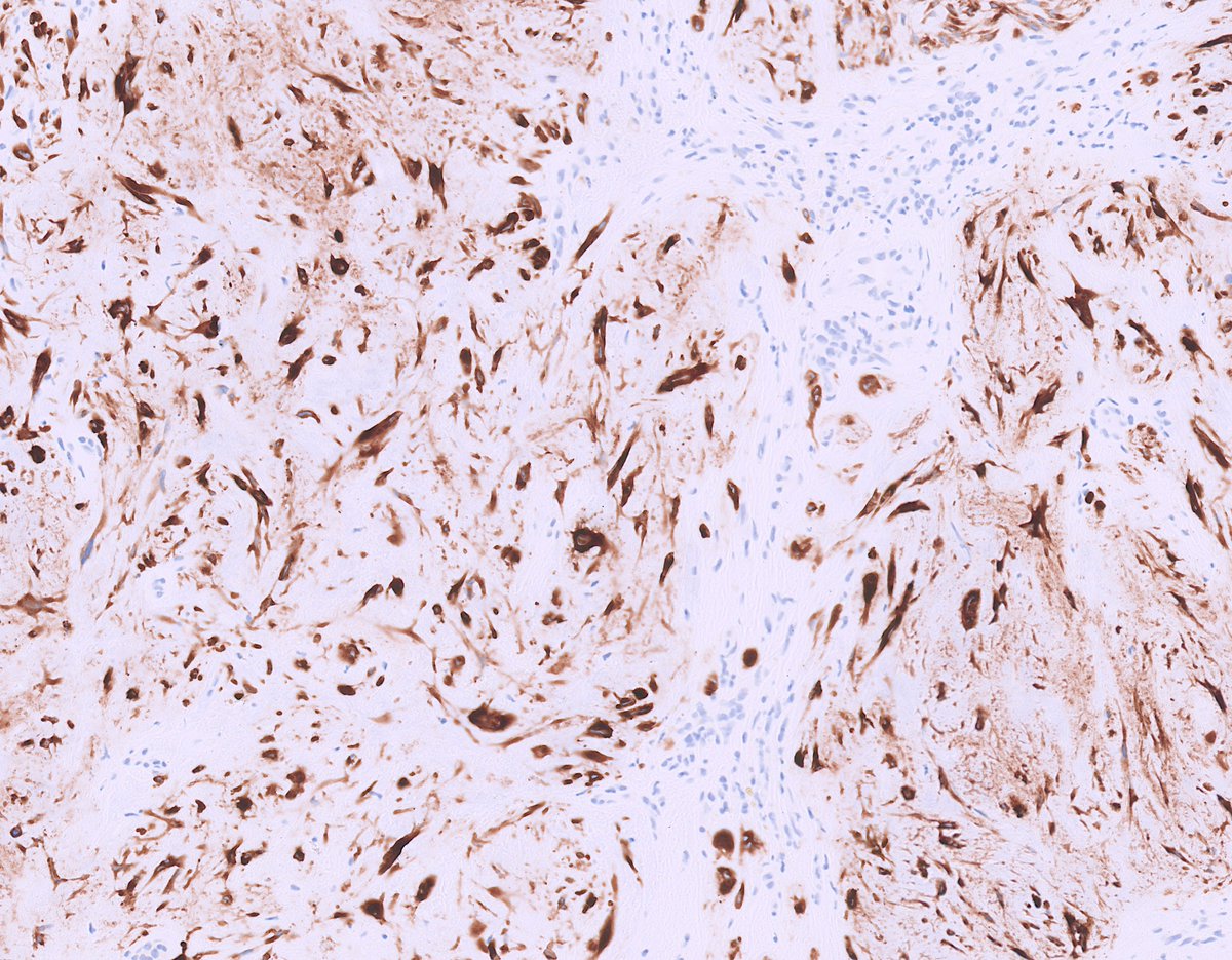 Cool new applications of GRM1 immunohistochemistry to diagnose chondromyxoid fibroma! #BSTpath #IHCpath #Cytopath Subcutaneous CMF: pubmed.ncbi.nlm.nih.gov/36810795/ CMF with FGF23 expression mimicking PMT: pubmed.ncbi.nlm.nih.gov/38303543/ Cytopathology diagnosis of CMF: pubmed.ncbi.nlm.nih.gov/38281480/