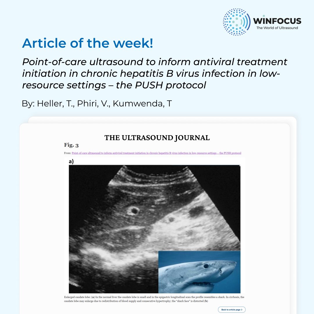 Article of the week: #Pointofcareultrasound to inform antiviral treatment initiation in chronic hepatitis B virus infection in low-resource settings – the PUSH protocol. By: Heller, T., Phiri, V., Kumwenda, T. Article link: shorturl.at/vyAD1