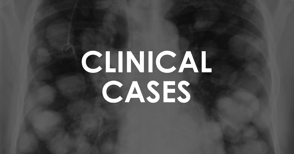 A 30-year-old with CML faces the aftermath of chemotherapy: Tumour Lysis Syndrome. A lab result labyrinth reveals a critical fight within. Explore the management of this oncological puzzle. #MedTwitter #MedEd #FOAMed litfl.com/troubling-lab-…
