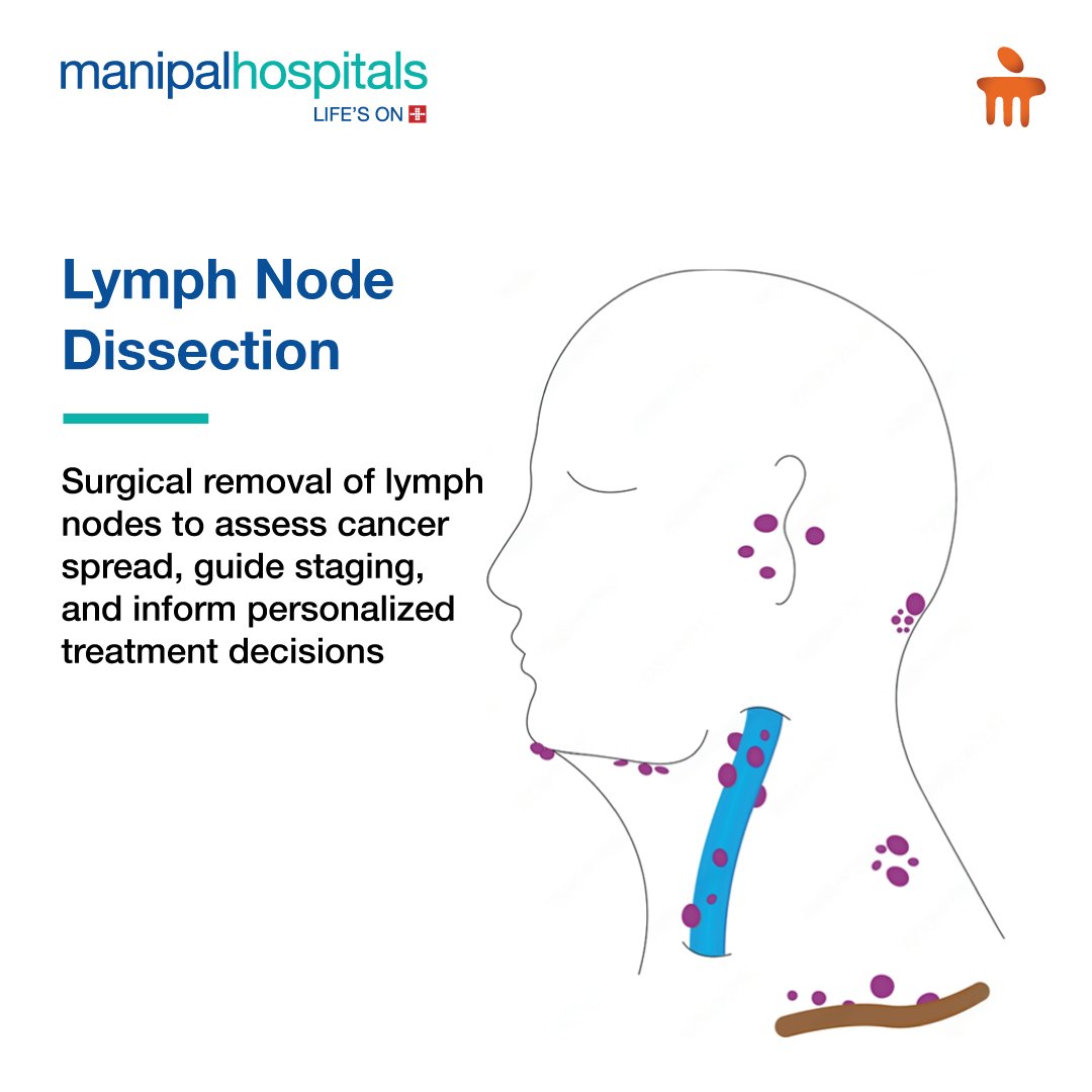 RajshekharJaka's tweet image. 🩺✨ What is Lymph Node Dissection? Discover its significance in cancer treatment and recovery. Stay informed! #LymphNodeDissection #CancerAwareness #HealthEducation #Manipalhospitals #ManipalhospitalWhitefield