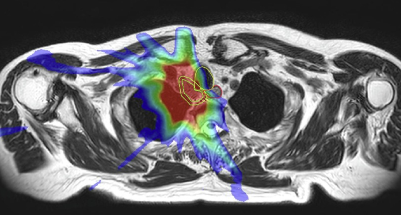 In @ctRO_journal, @UMCUtrecht clinicians detail their SBRT of (ultra)central lung tumors experience with Elekta Unity. Findings suggest #MRgRT could enhance the distinction between OARs and target volumes near the mediastinum and enable ITV modification for each fx in response to