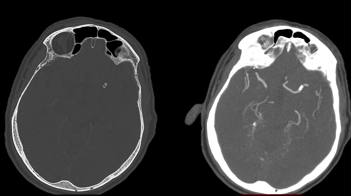 🫀🩹 #Stroke post heart valve surgery 🔎Can you guess the name of this device that caused partial MCA occlusion ?