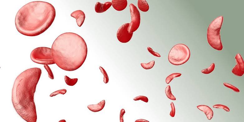 #Clinical_Case🦠

🔍 Which antibiotic should routinely be used for infection prevention in sickle cell disease?

A. Erythromycin
B. Doxycycline
C. Penicillin
D. Trimethoprim

#MedicalQuiz #SickleCellDisease #Antibiotics